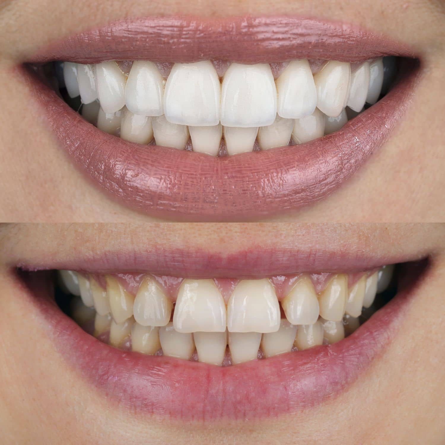 carillas-dentales- carillas dentales en maipú