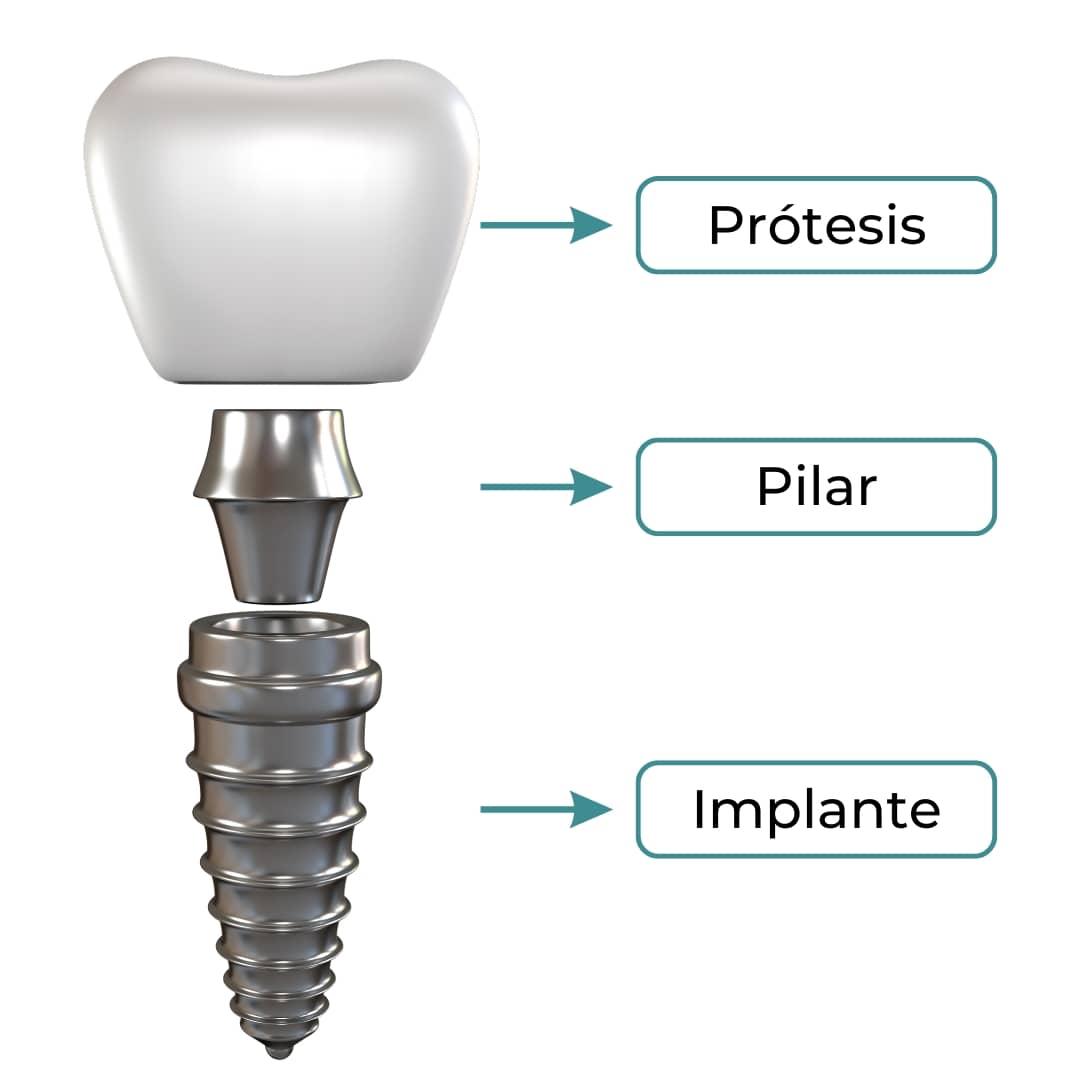 componentes-implante-dental componentes implante dental