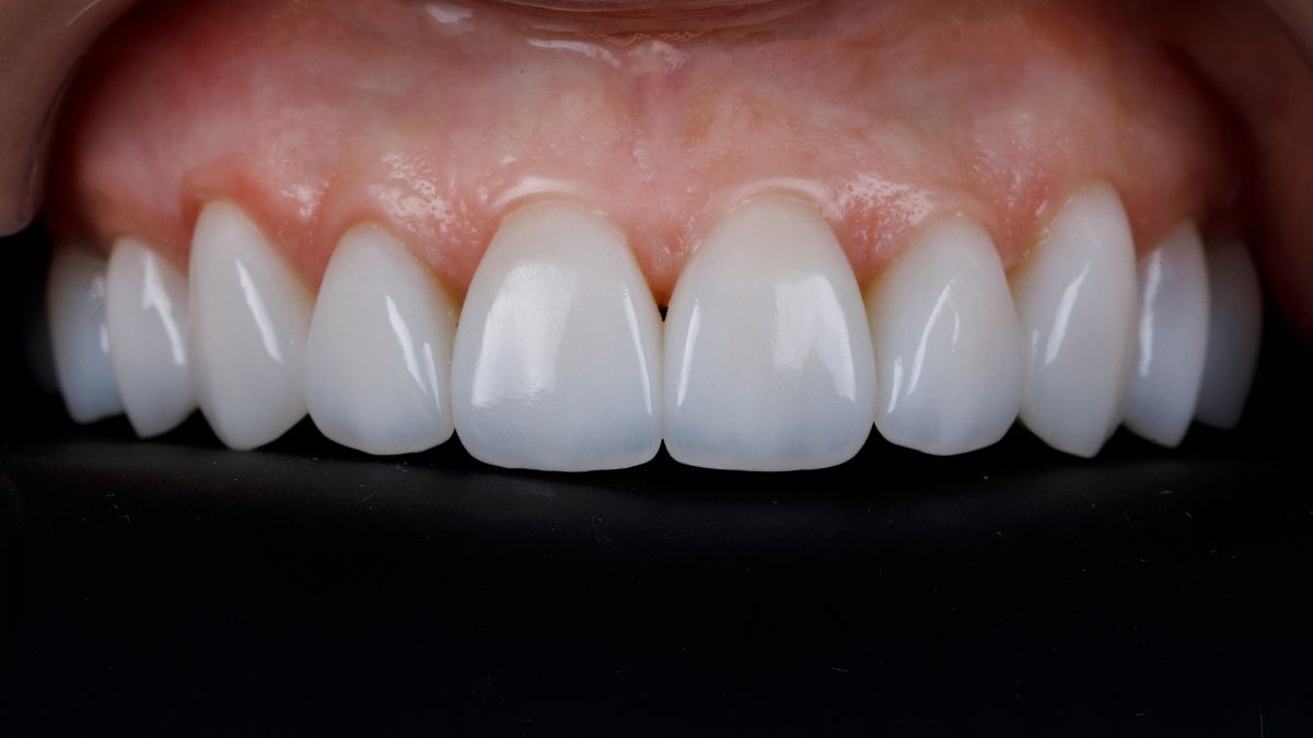carillas-dentales-clinica-jimenez carillas dentales